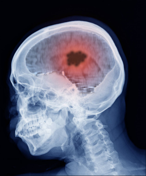 MRI scan hersenen met resultaat hersenkanker, hersenabces. - Foto, afbeelding