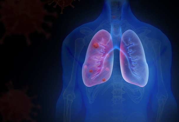 Людські легені, заражені вірусом і бактерією. Lungs Anatomy 3d ілюстрація - Фото, зображення