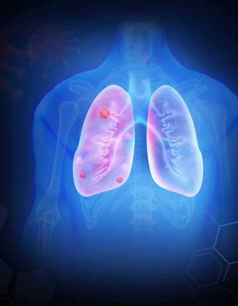 Ludzkie płuca zainfekowane wirusem i bakteriami. Płuca Anatomia. Ilustracja 3D - Zdjęcie, obraz