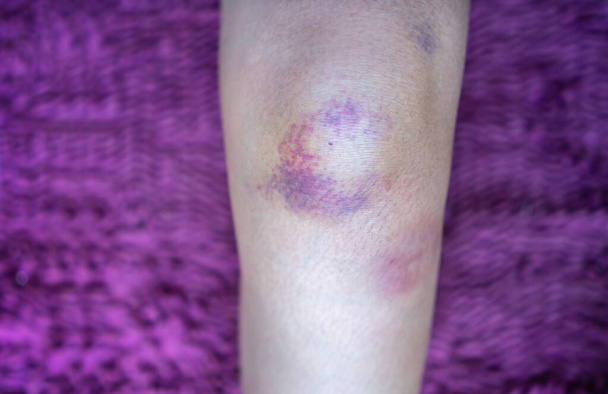 Close up bruise damage on knee of woman. - Photo, Image