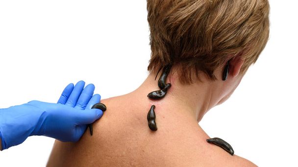 Krev sající pijavice hirudo medicinalis na ženských hlavách a ramenou. Ruka v modré rukavici drží pijavici - Fotografie, Obrázek
