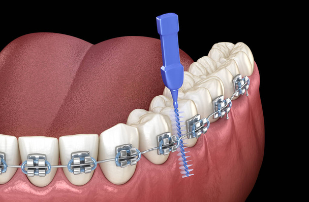 Mandidiční protézy vše na 8 systémech, které jsou podepřeny implantáty. Mediálně přesná 3D ilustrace koncepce zubů a zubní protézy - Fotografie, Obrázek