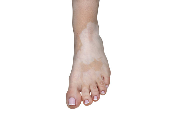 Stains from vitiligo disease on the left foot in a young Caucasian woman, isolated on a white background with a clipping path. - 写真・画像