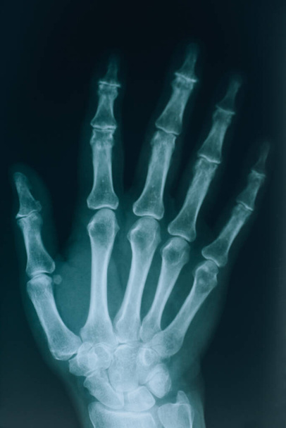 Rentgen rukou. Skutečný rentgenový snímek ruky s prsty. Na schůzce s lékaři v nemocnici. - Fotografie, Obrázek