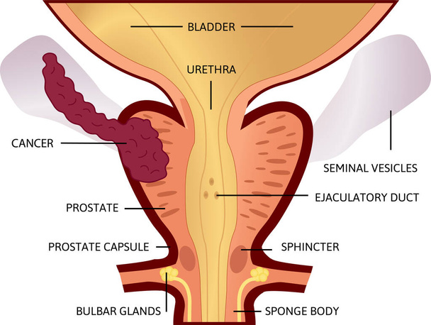 derde fase van prostaatkanker. De tumor is groot en bevindt zich in prostaat en ontwikkelde zich tot zaadblaasjes. - Vector, afbeelding