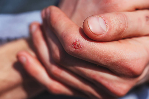 Los dedos nudillos del hombre. Manos masculinas de un trabajador de cerca. Llagas callosidades heridas en las manos
 - Foto, Imagen