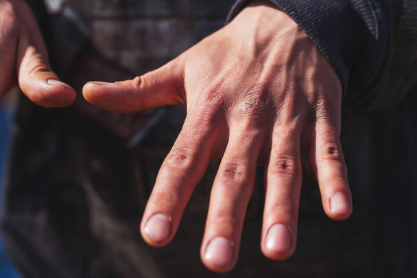 Les doigts cassés de l'homme. Mains masculines d'un ouvrier gros plan. Plaies cals plaies sur les mains
 - Photo, image