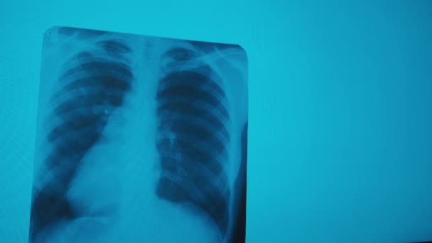 COVID-19. Lungenentzündung in der Lunge im Bild eines Patienten. Doktor der Medizin. Siehe Diagnostische Analyse. Röntgenzentrum. - Filmmaterial, Video
