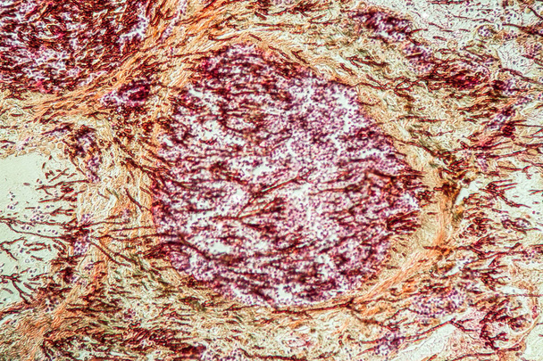 Инфекция легких кандидой и аспергиллусом у больных СПИДом 200x
 - Фото, изображение