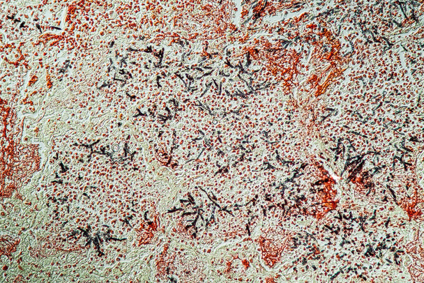 AIDS患者におけるカンジダおよびアスペルギルスへの肺感染200x - 写真・画像