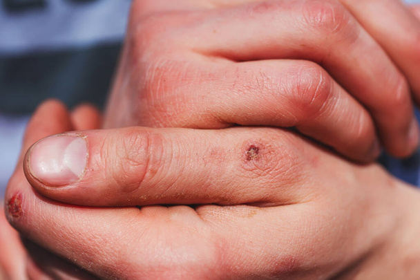 Der Mann hatte die Finger am Knöchel. Männliche Hände eines Arbeiters in Großaufnahme. Schmerzen Schwielen Wunden an den Händen - Foto, Bild
