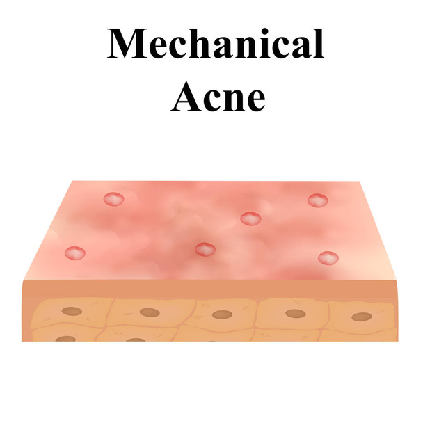 Closed comedones. Acne on the skin. Dermatological and cosmetic diseases on the skin of the face acne. Infographics. Vector illustration on isolated background. - Vector, Image
