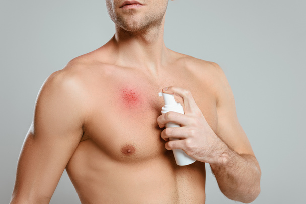 Vista recortada del hombre aplicando espuma sobre el enrojecimiento de la piel aislada sobre gris
 - Foto, imagen