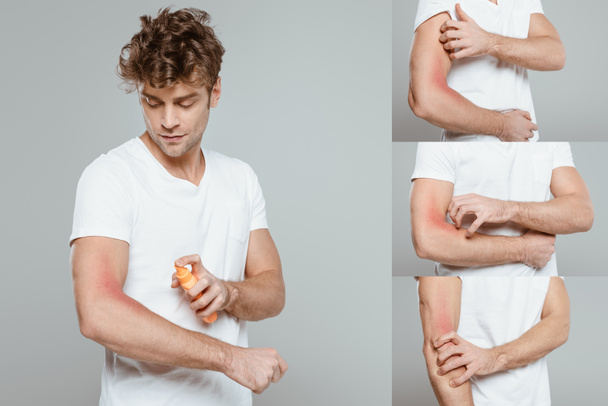 Collage di uomo che applica protezione solare e graffia mano con allergia sul grigio
 - Foto, immagini
