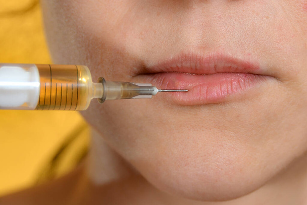 Lip injections with a syringe for lip augmentation in a beauty salon. - 写真・画像