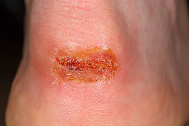 Close-up foto van pijnlijk letsel op de hiel - Foto, afbeelding
