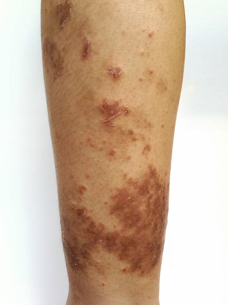 O rapaz tem erupção crónica na pele. Doença alérgica da pele da grama. Dermatite atópica. Idade mancha pele
. - Foto, Imagem