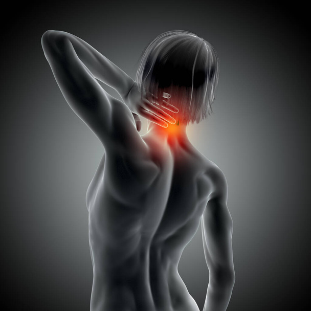 3D-mallinnus lääketieteellisestä kuvasta, jossa naaras pitelee kaulassa kipua - Valokuva, kuva