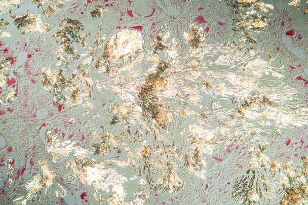 Arthritis gout crystals in the cells tissue section 100x - Photo, Image