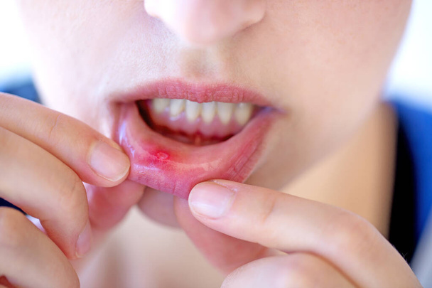 Жінка, що показує червону і болючу рану болить всередині її губи
 - Фото, зображення