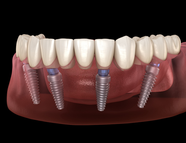 Prótesis mandibular Todo en 4 sistemas soportado por implantes. Ilustración 3D médicamente precisa del concepto de dientes humanos y prótesis dentales - Foto, imagen