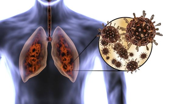 Koronawirus atakuje ludzkie płuca i powoduje zapalenie płuc. Zakażenie płuc - covid-19, vcov 2019. Wirus mikroskopu zbliżenie - 3d renderowania. - Zdjęcie, obraz