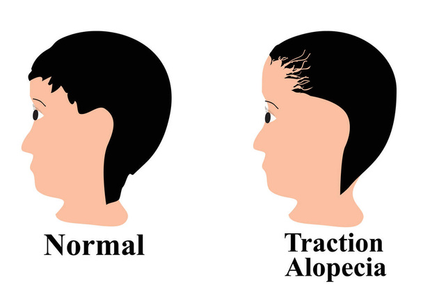 Alopécia haj. Kopaszság a fejen. Vontatási alopecia. Infografikák. Vektorillusztráció izolált háttérrel. - Vektor, kép
