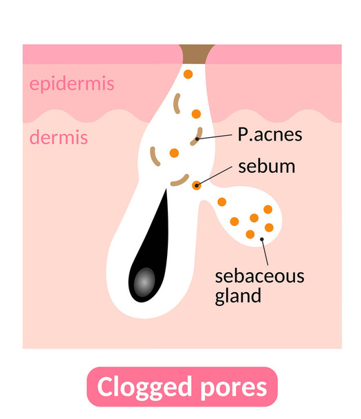 Wtyczki Sebum powoduje zatkane pory, które prowadzą do trądziku. Koncepcja pielęgnacji skóry - Wektor, obraz
