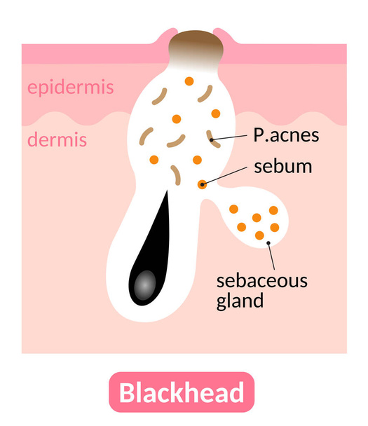 Mustapäät ovat pieniä kuoppia, jotka näkyvät iholla tukkeutuneiden huokosten vuoksi. Ihonhoidon käsite
 - Vektori, kuva