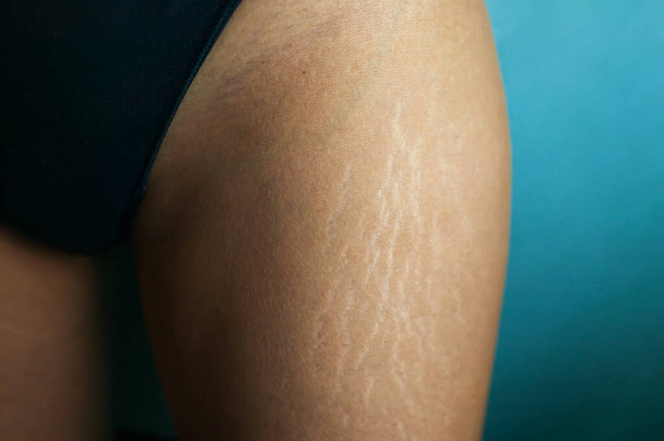 Stretch markeringen op vrouwenbenen. Vrouwelijke hand houdt dikke cellulitis vast en strekt littekens op haar been. Celluliet. - Foto, afbeelding