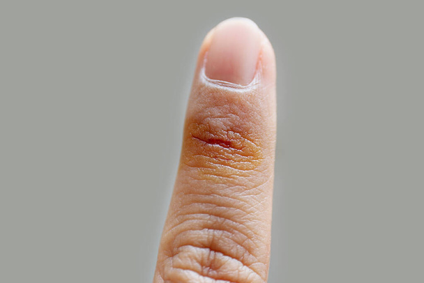 Corte ferida lesão do dedo do acidente e primeiros socorros por solução anti-séptica em fundo cinza, foco seletivo
 - Foto, Imagem