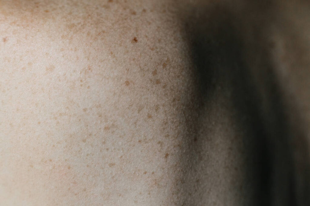 Checking benign moles. Close up detail of the bare skin on a man back with scattered moles and freckles. Sun effect on skin. Pigmentation. - 写真・画像