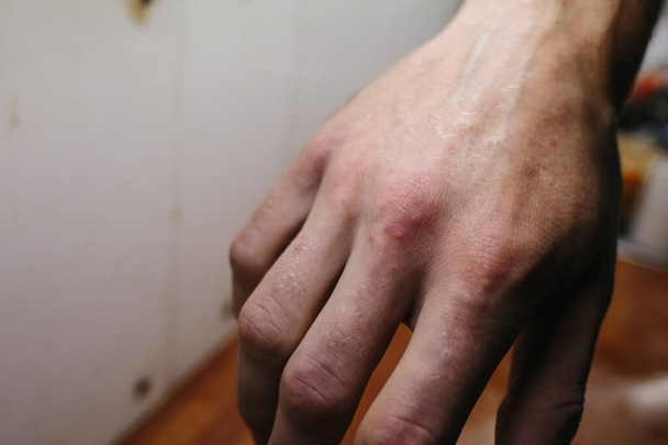 Psoriasis skin. It is an autoimmune disease that affects the skin cause skin inflammation red and scaly. - 写真・画像