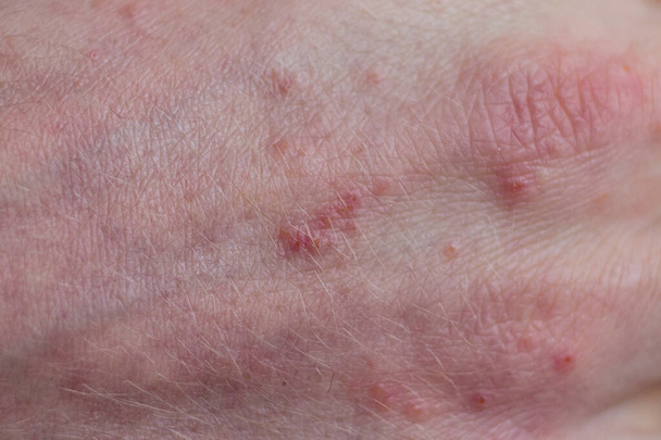 close-up of a patients fingers showing plaques of dry skin typically seen with psoriasis. Skin problems - Photo, Image