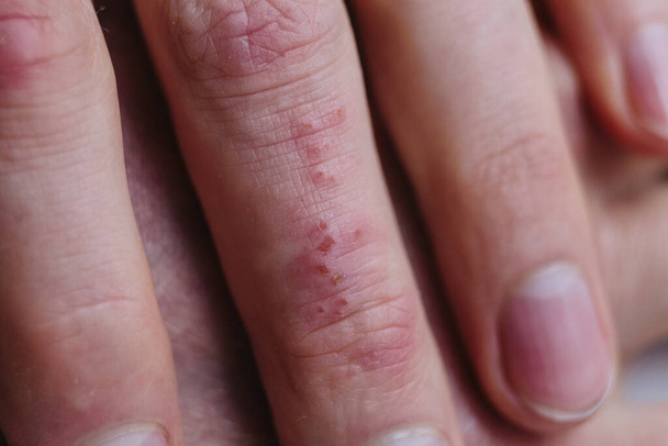 乾いた皮膚の板を示す患者の指のクローズアップは、一般的に乾癬で見られます。皮膚の問題 - 写真・画像