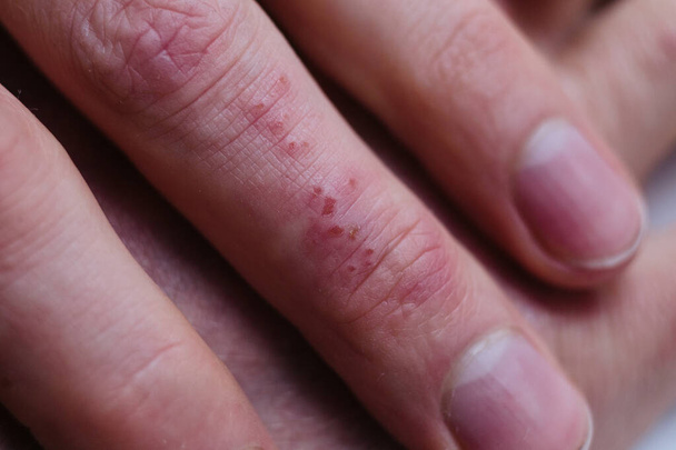 zbliżenie palców pacjentów wykazujących płytki z suchą skórą zwykle obserwowane z łuszczycą. Zaburzenia skóry - Zdjęcie, obraz