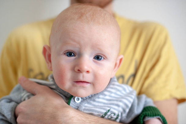 Seborrheic dermatitis in a baby - Foto, Bild