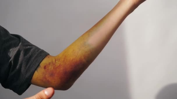Intense bruising from a dislocated elbow joint and ligament damage on man. The bruise is approximately two weeks old and starting to recede. - Materiał filmowy, wideo