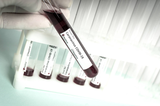 Mão detém um tubo de teste contendo uma amostra de sangue, tubo de teste para análise de coronavírus Covid-19. Exame laboratorial amostra de pacientes
 - Foto, Imagem