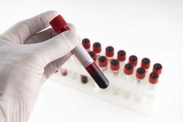 Elinde kan örneği içeren bir test tüpü var. Covid-19 koronavirüs analizi için test tüpü. Laboratuvar test hastaları örneği - Fotoğraf, Görsel