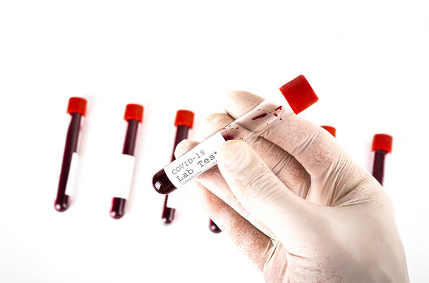 Hand holds a test tube containing a blood sample, test tube  for Covid-19 coronavirus analyzing. Laboratory testing patients sample - Zdjęcie, obraz
