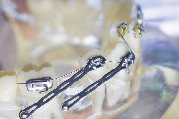 Attaches métalliques modernes et algners en plastique fil consoles dentaires redresseurs de dents
. - Photo, image