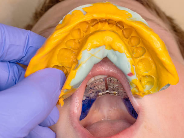 Dentysta używający odcisków dentystycznych do sprawdzania aparatu ortodontycznego młodego pacjenta. Zbliżenie. Prawdziwi ludzie.. - Zdjęcie, obraz