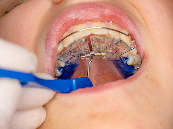 Hyrax Genişletici RPE aracı ile doktor ayarı, Especial palatal diş telleri doğum kusurunu düzeltmek için. - Fotoğraf, Görsel
