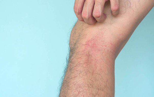 Gros plan homme main éraflure éruption allergique sur la peau des jambes, les soins de santé et le concept médical
 - Photo, image