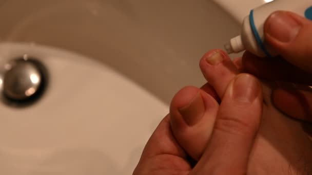 Zbliżenie paznokcia na prawej stopie białego mężczyzny. Objawy grzybicy są widoczne na gwoździu w pobliżu dużego palca..  - Materiał filmowy, wideo