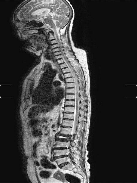 RM della colonna vertebrale lombare Lo studio rivela frattura scoppiata del corpo vertebrale L2, appare come grave diminuzione dell'altezza del disco e ampliamento della distanza interpedicolare
. - Foto, immagini