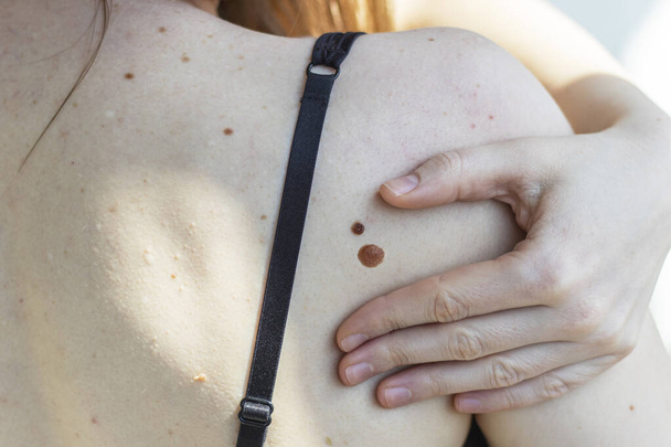 Крупный план женской кожи на плече со многими родинками
. - Фото, изображение