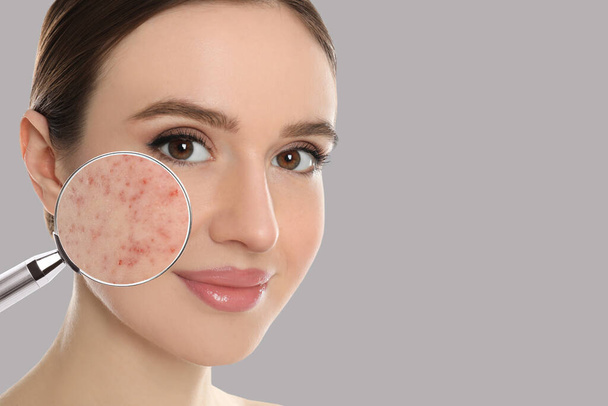 Young woman with acne problem on grey background, space for text. Skin under magnifying glass - Fotó, kép