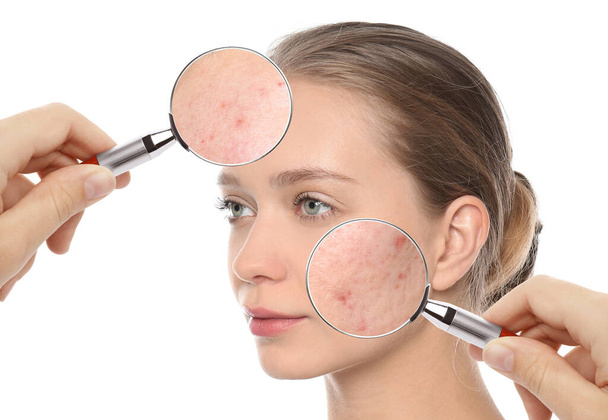 Young woman with acne problem visiting dermatologist, closeup. Skin under magnifying glass - 写真・画像